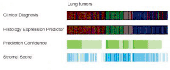 Image: Histological types are labeled by different colors in the clinical diagnosis and histology expression-predictor tracks. Prediction confidence and stromal score are shaded green to white to blue indicating high to low values. The highest quality predictions exhibit high confidence and low stromal scores (Photo courtesy of the University of North Carolina).